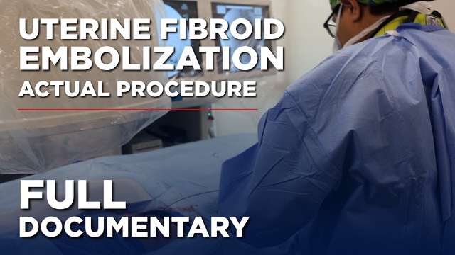 Video: a full documentary of a real uterine fibroid embolization performed at ARVC