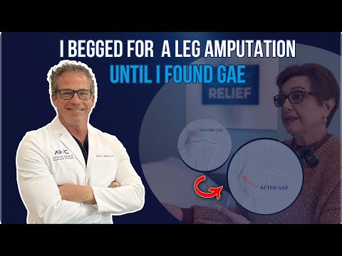 Video: an ARVC patient who had 23 knee surgeries shares her experience with GAE