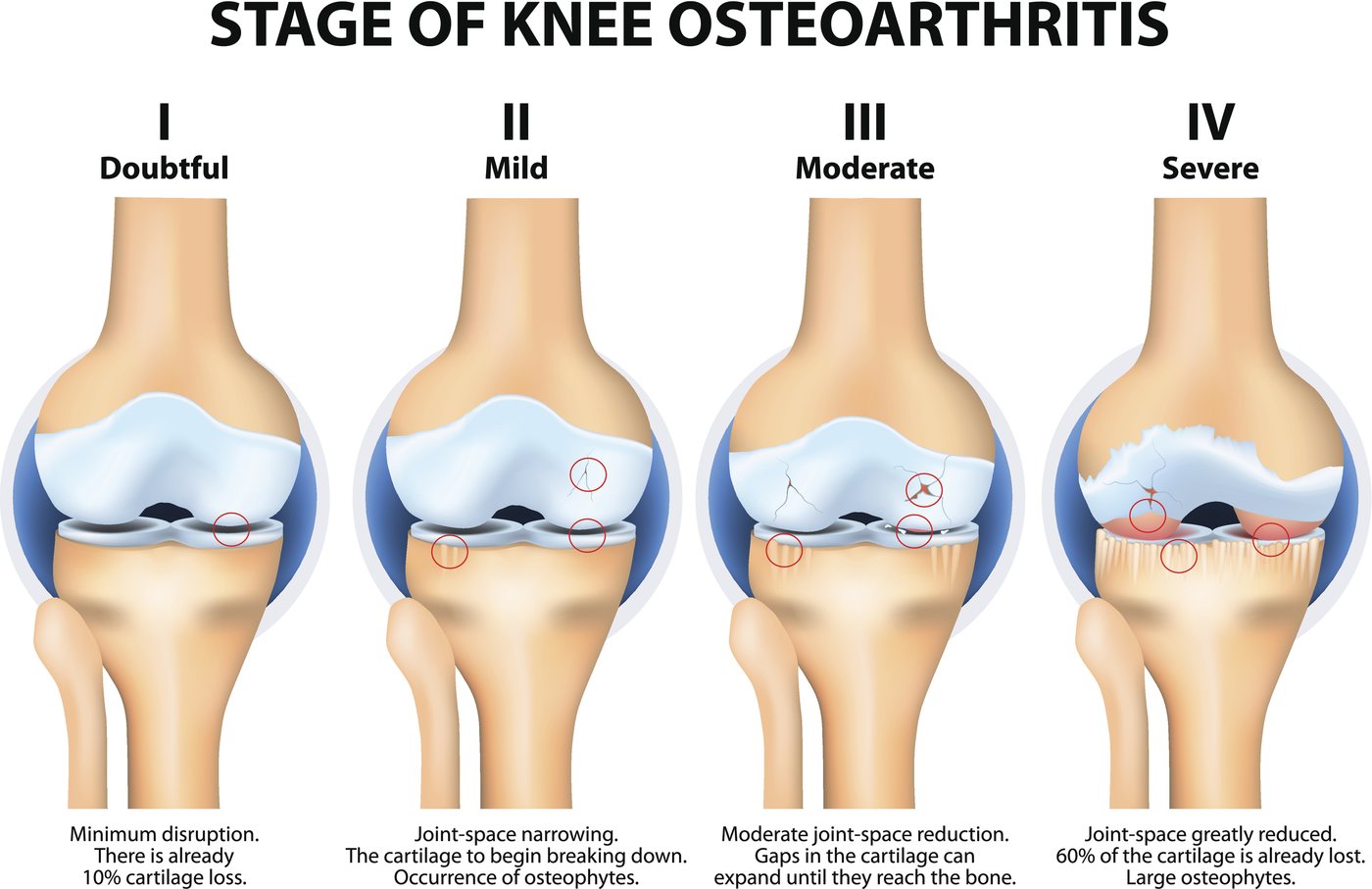 Diagram of the four stages of knee osteoarthritis: stage I doubtful with minimum disruption, stage II mild with joint-space narrowing and early bone spurs, stage III moderate with reduced joint space and gaps in the cartilage, and stage IV severe with greatly reduced joint space and large bone spurs