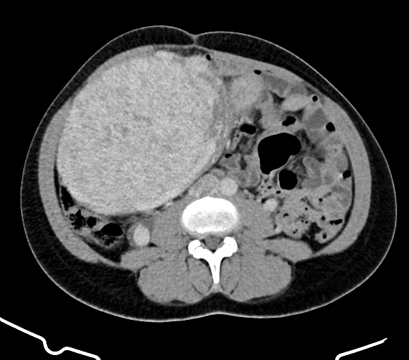 Cross-sectional CT scan of the abdomen showing a large rounded mass filling the right side of the abdomen and pushing the bowel aside