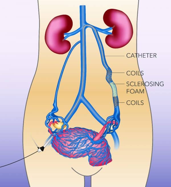 Illustration of pelvic vein embolization: a catheter passed up into the left ovarian vein, with coils placed above and below a section filled with sclerosing foam, and swollen veins around the uterus below