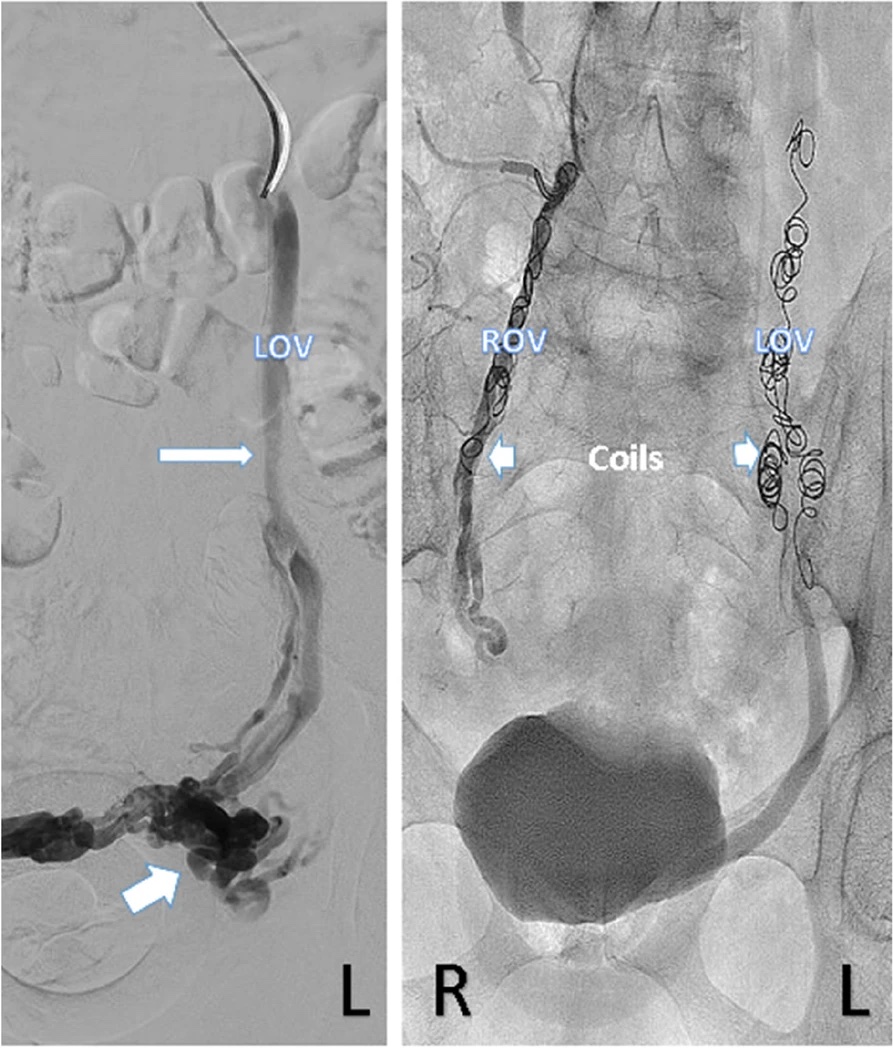 Two venogram images. Left, labelled LOV: a wide left ovarian vein draining into a dark cluster of swollen pelvic veins. Right, labelled ROV and LOV: coils in place in both ovarian veins after treatment.