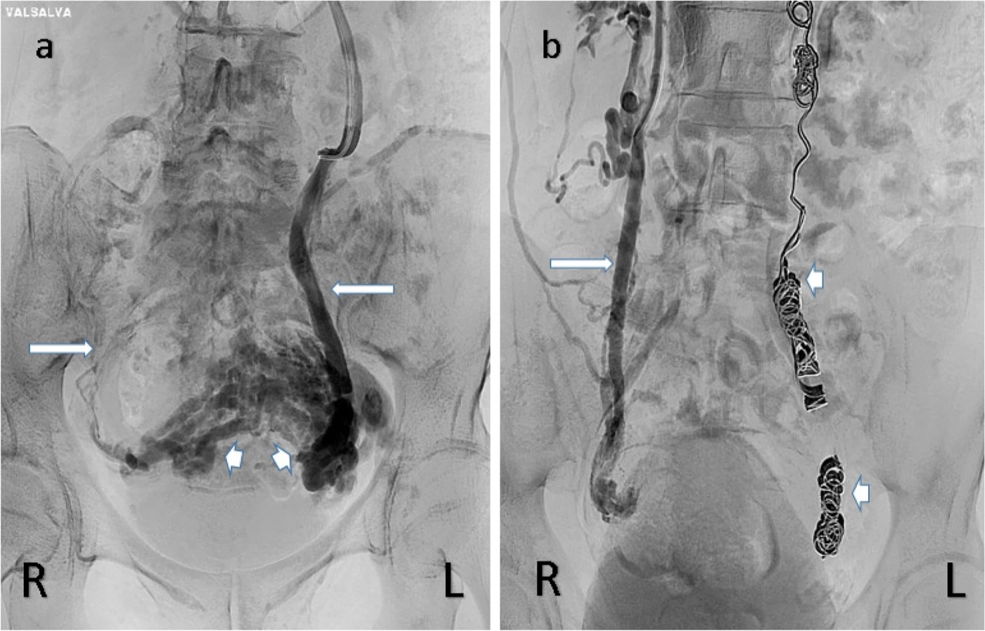 Two venogram images of the pelvis. Left: a wide left ovarian vein carrying contrast down into a dark tangle of swollen veins around the uterus. Right: coils in the left ovarian vein, and contrast filling a wide right ovarian vein with varicose veins below it.