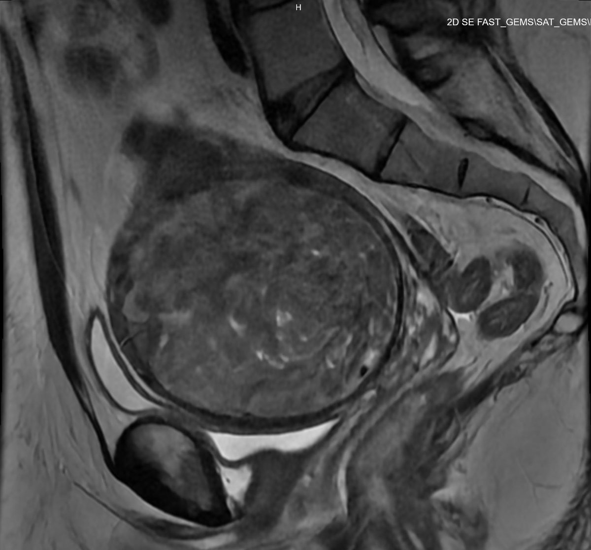 Sagittal pelvic MRI showing a large fibroid uterus filling the pelvis and pressing down on the bladder