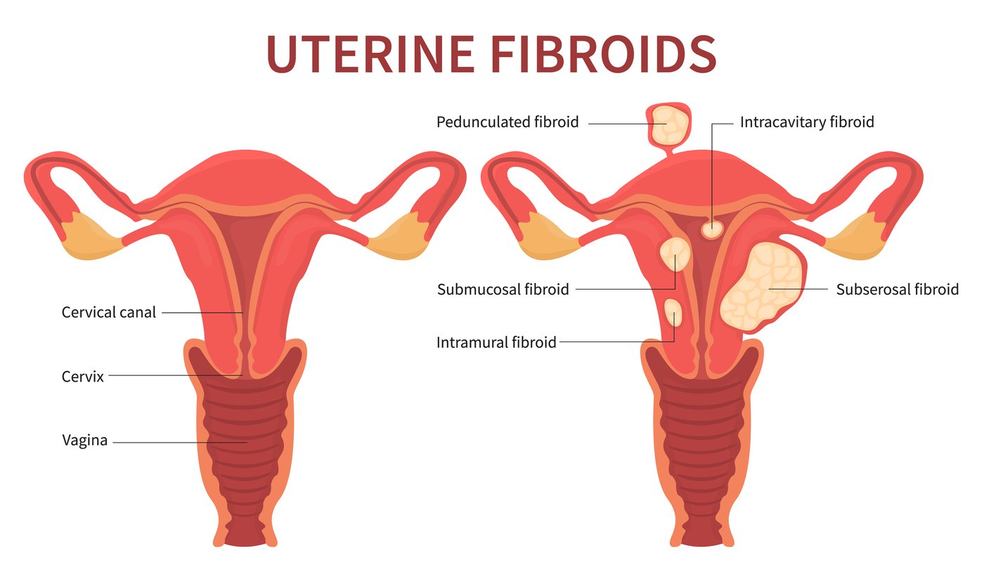Diagram comparing a normal uterus with a fibroid uterus, labelling pedunculated, intracavitary, submucosal, intramural and subserosal fibroids